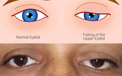 What Is Ptosis? Understanding Drooping Eyelids | LJ Eye Institute, Patiala